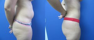 Redefinición del contorno corporal con liposucción. Vista lateral derecha: resultados visibles, proporciones equilibradas.  
Dr. Ricardo Bonilla – Pereira, Colombia.