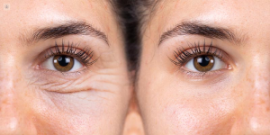 Blefaroplastia en Pereira. Dr. Ricardo Bonilla