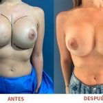 Renovación de prótesis mamarias con resultados naturales y armoniosos. Técnica aplicada por el Dr. Ricardo Bonilla.