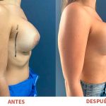Renovación de prótesis mamarias con resultados naturales y armoniosos. Técnica aplicada por el Dr. Ricardo Bonilla.