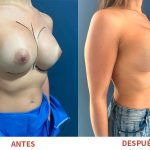 Renovación de prótesis mamarias con resultados naturales y armoniosos. Técnica aplicada por el Dr. Ricardo Bonilla.