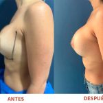 Renovación de prótesis mamarias con resultados naturales y armoniosos. Técnica aplicada por el Dr. Ricardo Bonilla.