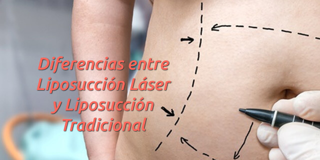 Diferencias entre Liposucción Láser y Liposucción Tradicional