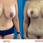 Resultados postoperatorios de Liposucción y Explantación de Senos. Trabajo del Dr. Ricardo Bonilla.