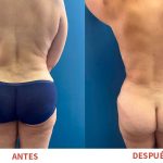 Resultados postoperatorios de Liposucción y Explantación de Senos. Trabajo del Dr. Ricardo Bonilla.