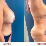 Resultados postoperatorios de Liposucción y Explantación de Senos. Trabajo del Dr. Ricardo Bonilla.