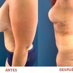 Resultados postoperatorios de Liposucción y Explantación de Senos. Trabajo del Dr. Ricardo Bonilla.