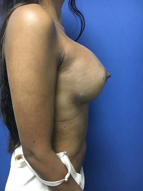 Mamoplastia de aumento en Pereira - Dr. Ricardo Bonilla