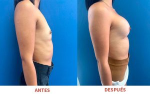 Transformación estética con mamoplastia de aumento: técnica avanzada Ergomix. Dr Ricardo Bonilla.
