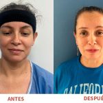 Corrección estética de orejas mediante otoplastia realizada por el Dr. Ricardo Bonilla. Resultados naturales y simetría facial mejorada.
