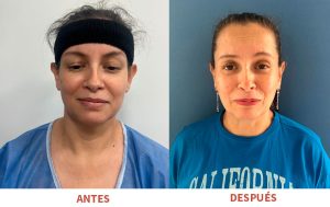 Corrección estética de orejas mediante otoplastia realizada por el Dr. Ricardo Bonilla. Resultados naturales y simetría facial mejorada.