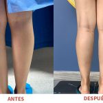 Aumento de pantorrillas realizado por el Dr. Ricardo Bonilla en Pereira. Resultados definidos y proporciones armoniosas.