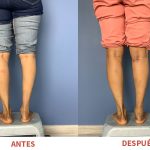 Implantes de pantorrilla para mejorar volumen y simetría. Técnica especializada del Dr. Ricardo Bonilla en Pereira.